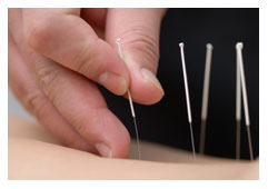 Acupuncture 